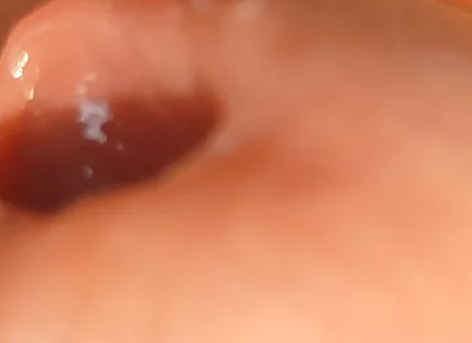 The Great Transformation of Phimosis Elastica.