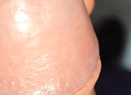 Extreme Application to the Syringe Inside the Glans!!