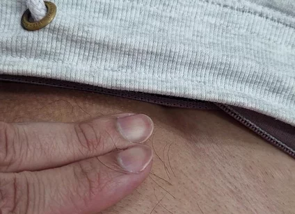 The Hair on My Penis - Led Hair Removal