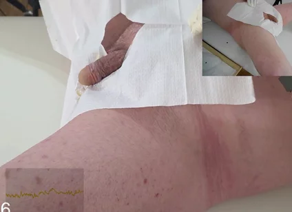 16 French Foley Insertion