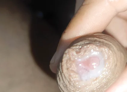 I Have the Largest Ejaculating Phimosis in the World!!