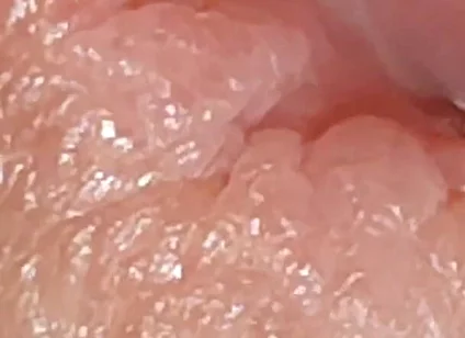 Enlargement of the Deep Urethral Hole!!