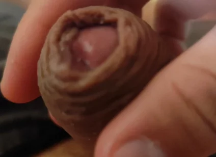 Great Phimosis Getting in the Way of the Boy's Orgasm