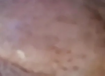 Extreme Fillings Inside My Siliconemeat
