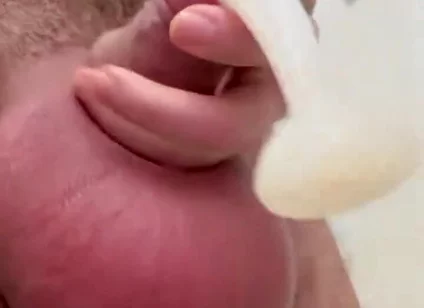 Inflated Ball Sack with Saline