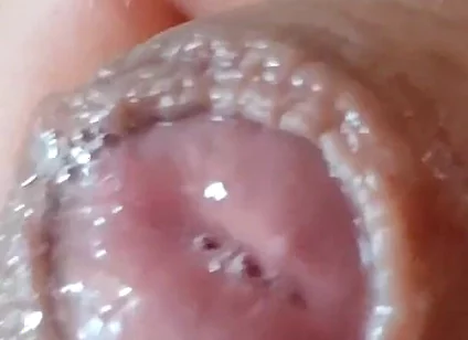 Deep Split in the Glans Produces Bubbling Liquid