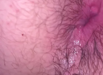 Bruised Asshole