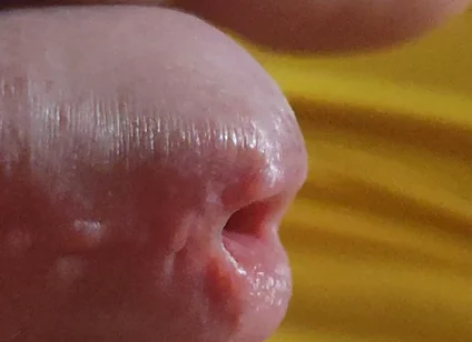 Scarred Frenulum Causes Glans Erection!