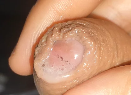 Curious Close-up of Pre-cum in Flaccid Phimosis.