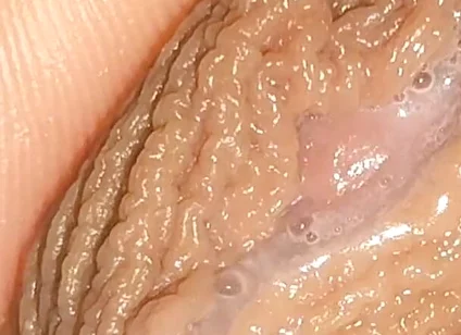 Curious Close-up of Pre-cum in Flaccid Phimosis.