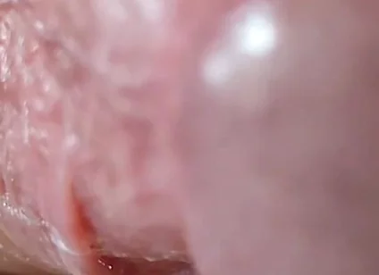 Opening the Scar of the Rough Frenulum!