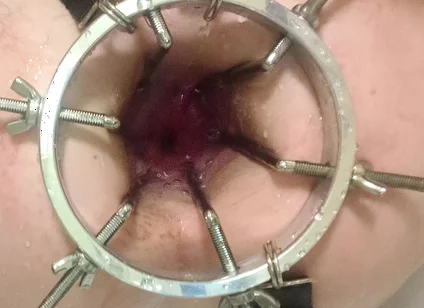 Enema, Anal Shower. Close-up View Through Anal Mirror. Anal with Water. Filling Anal with Water