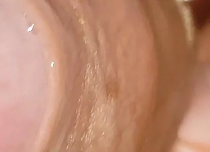 Large Cheese Accumulated in Close up of Glans