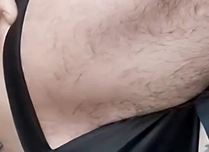 A Sperm Injection