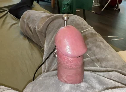Acorn Acupuncture in a Cozy Cuddly Suit! Lots of Sperm!