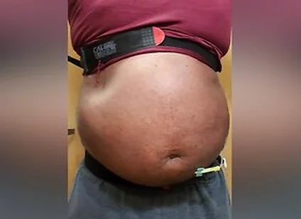 N2o Belly Inflation