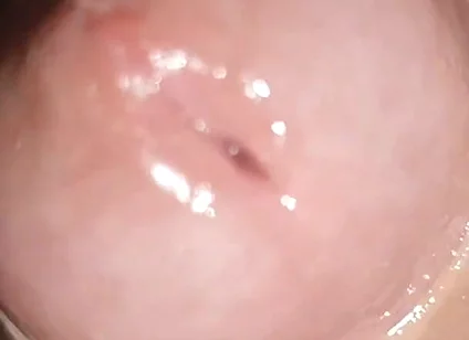 Maximum Dilation of Phimosis Cumming.