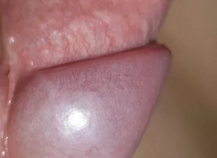 Amazing Upright Rough Venous Frenulum