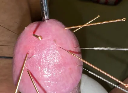 Acupuncture - Orgasm!