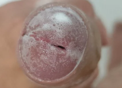 Extreme Burning Sensation Makes the Glans Foam with Arousal.