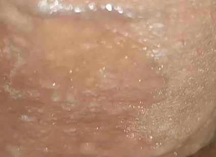 Scrotal Phimosis Results in an Extremely Hot Orgasm.