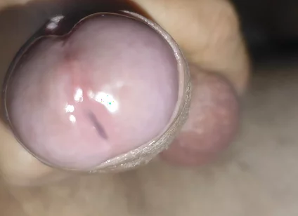 Scrotal Phimosis Results in an Extremely Hot Orgasm.