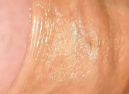 Difficult Fluid Control Due to Straight Phimosis.